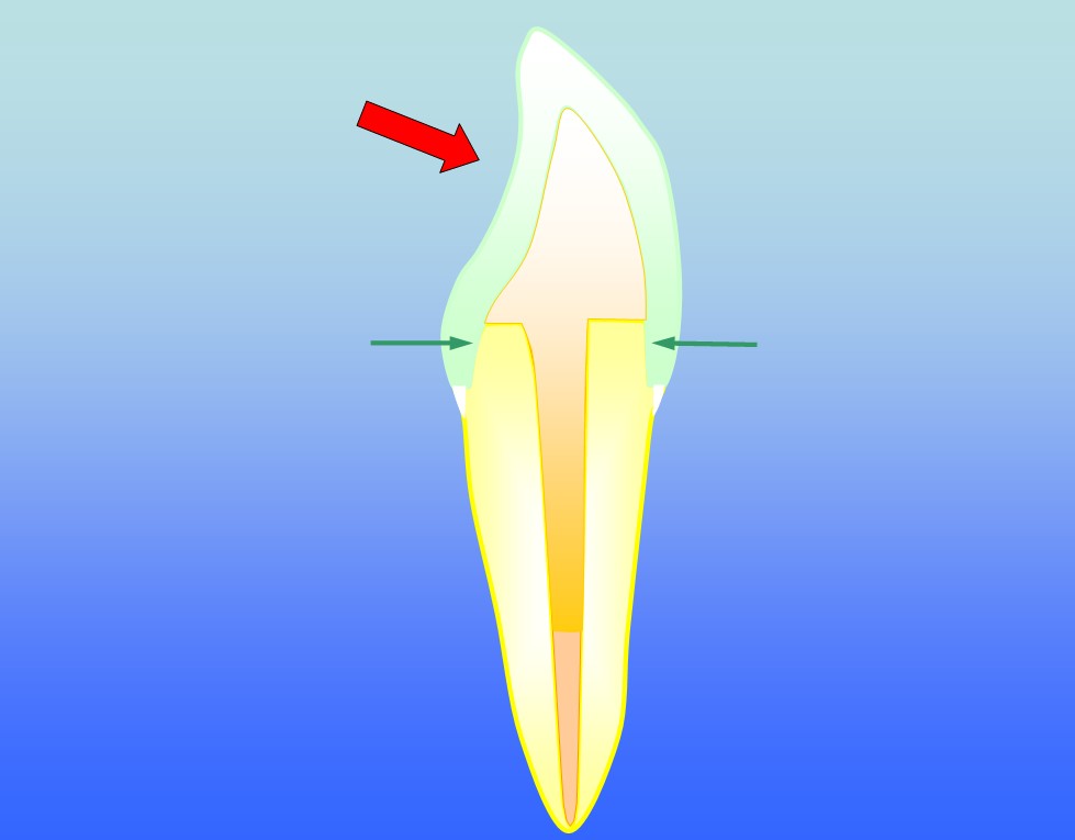 incisor gg